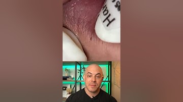 Doctor reacts to super satisfying pimple pops! #dermreacts #doctorreacts #pimplepop #cystpop