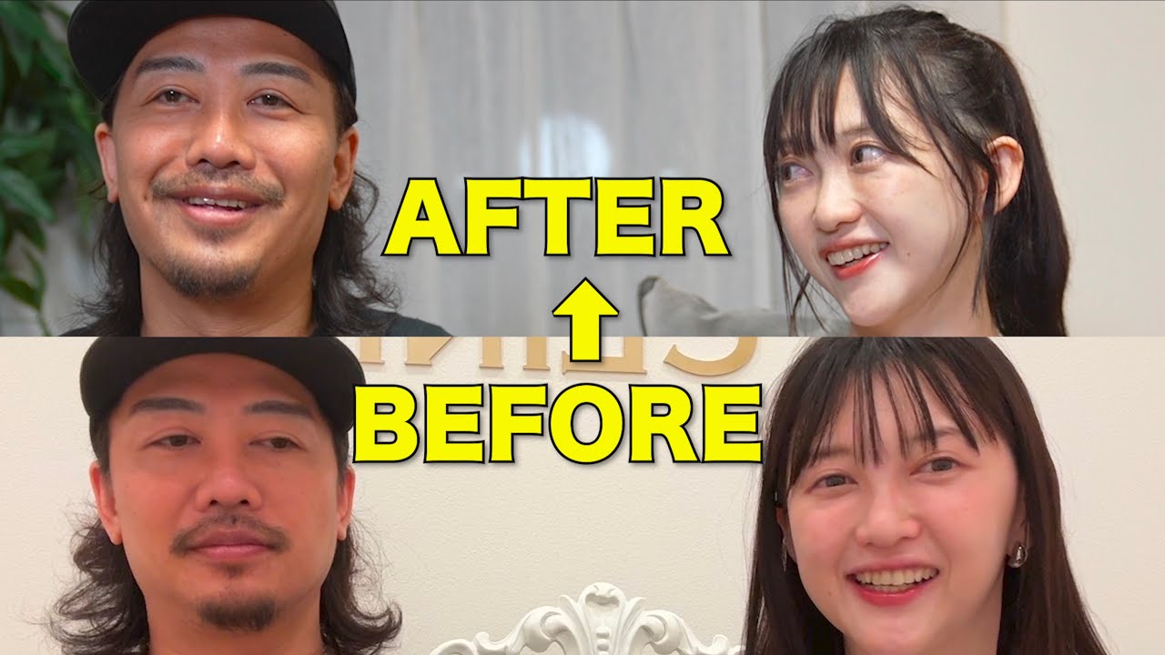 40-year-old plastic surgery report] Thread lift and liposuction