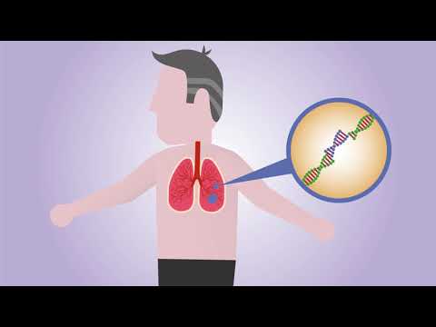Wie wird ALK-positiver Lungenkrebs behandelt?