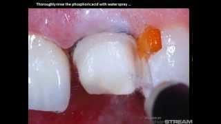 Variolink Ii Wz Excite Dsc