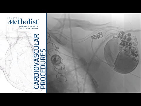 Endovascular Treatment of