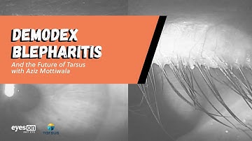 Demodex blepharitis and the future of Tarsus