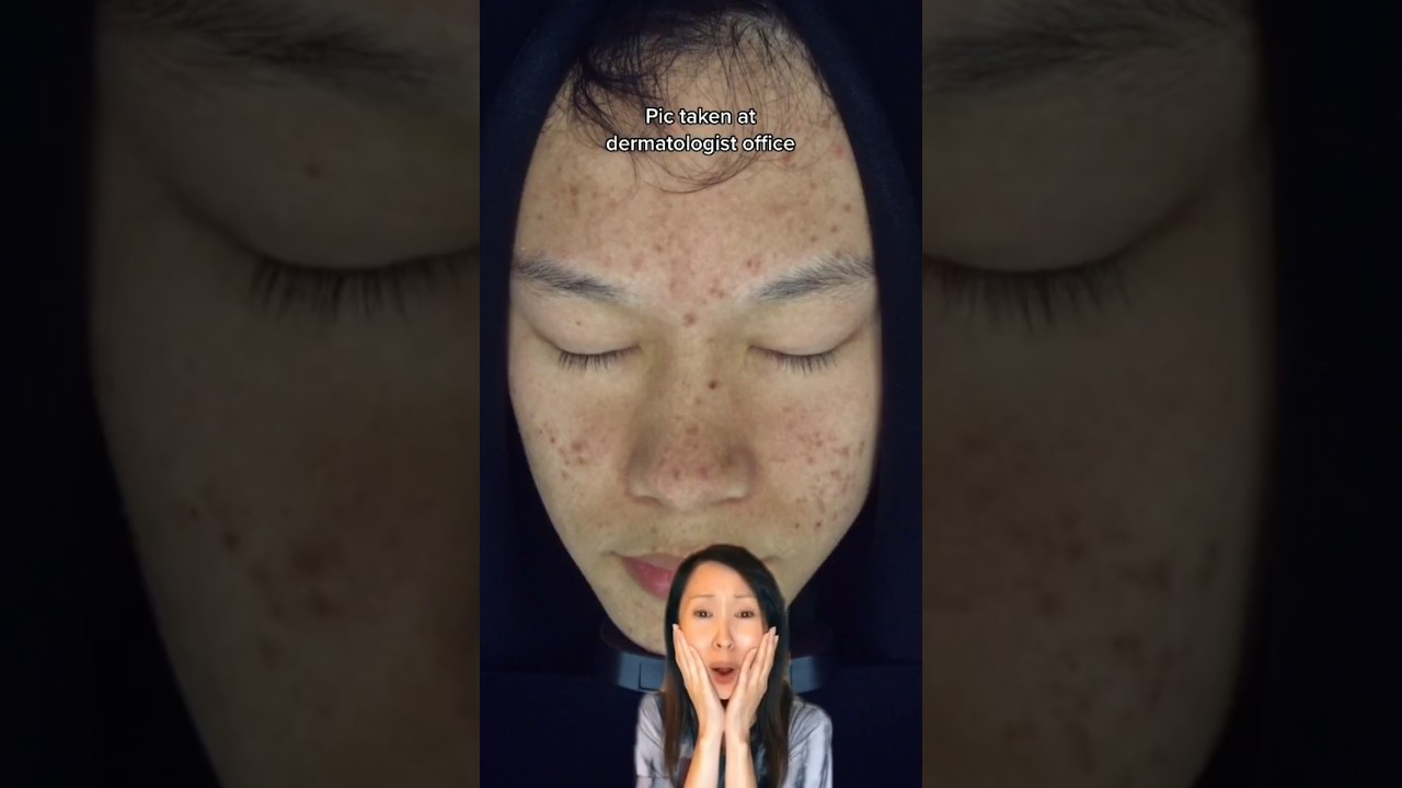 One of my first viral videos posted 4 years ago today #onthisday #skincare #storytime #acne #pimple
