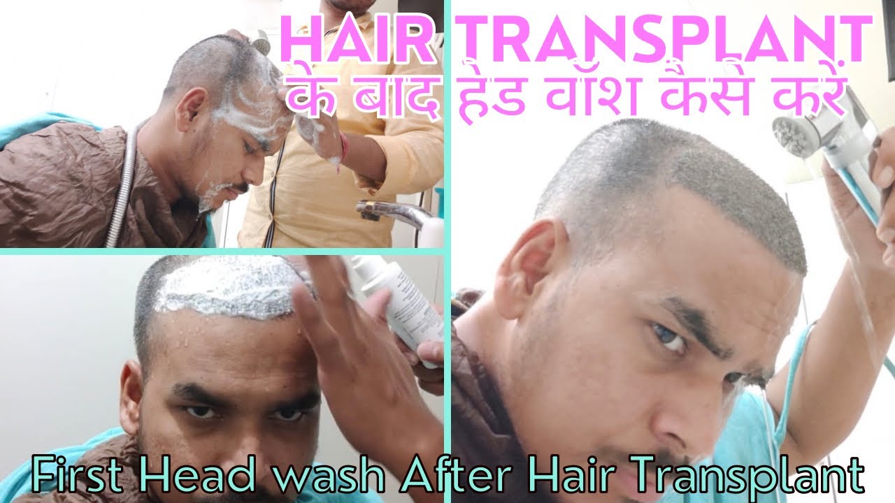 First Head wash After Hair Transplant hair transplant ke bad head
