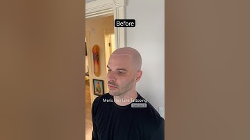 Men’s before and after SMP scalp micropigmentation #smp #scalpmicropigmentation