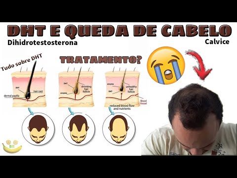 Dihidrotestosterona (DHT) e Queda de Cabelo / Calvicie