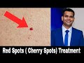 Red Skin Dots ( cherry Angioma ) Natural Treatment | Dr. Vivek Joshi