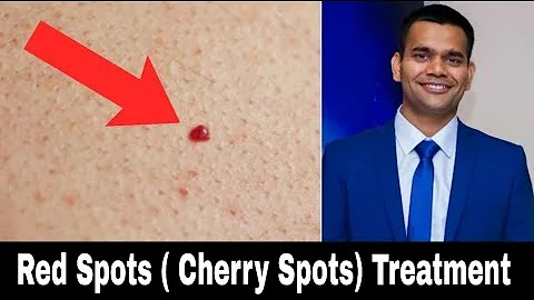 Natural Treatment for Cherry Spots: Say Goodbye to Red Skin Dots!