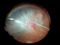 Vitrectomy for preretinal haemorrhage in advanced proliferative diabetic retinopathy