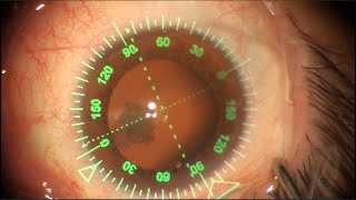 Como é feita a Cirurgia de Catarata