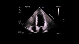 Relaxing Echo Of My Heart With My Heartbeat Sound Asmr