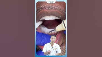 Bọc Răng Sứ Có Phải Lấy Cao Răng Không ? | Bác Sĩ Yên