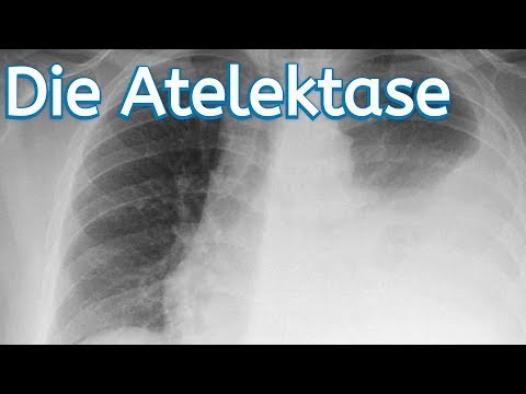 Video: Atelektase: Definition, Symptome, Typ, Ursachen Und Behandlung