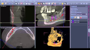 Implant editor & positioning