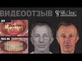 Импланты Nobel после рака челюсти. Отзыв пациента