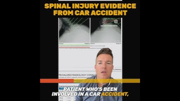 Flexion Extension X-Rays - Spinal Ligament Injuries