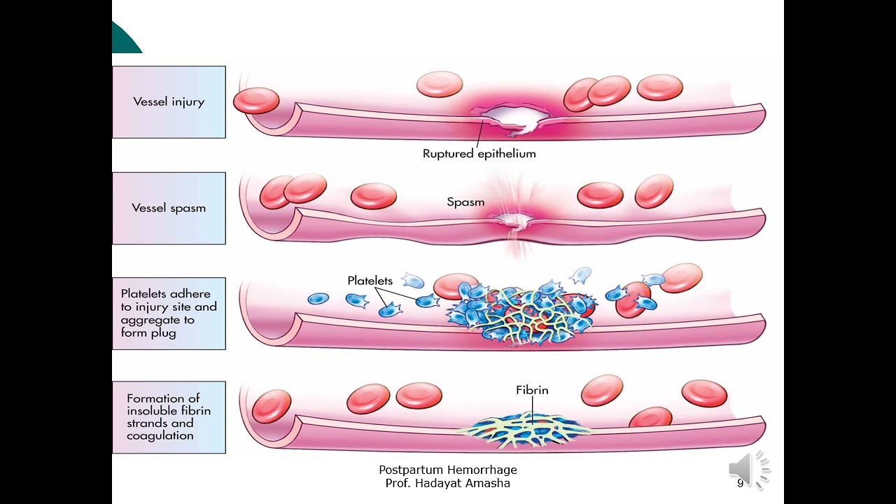 Postpartum hemorrhage