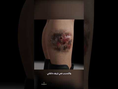 ماذا سيحدث لو ت ركت لدغة الأفعى بدون علاج