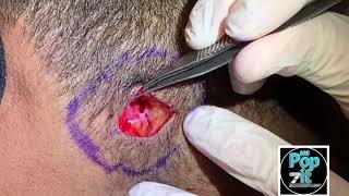 Giant Pilar cyst! Multiple cysts on scalp. Sac removal coming soon. Interesting cyst dissection.