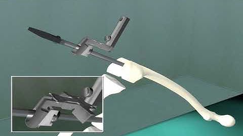 Buechel-Pappas Total Knee Replacement Surgery Animation Video