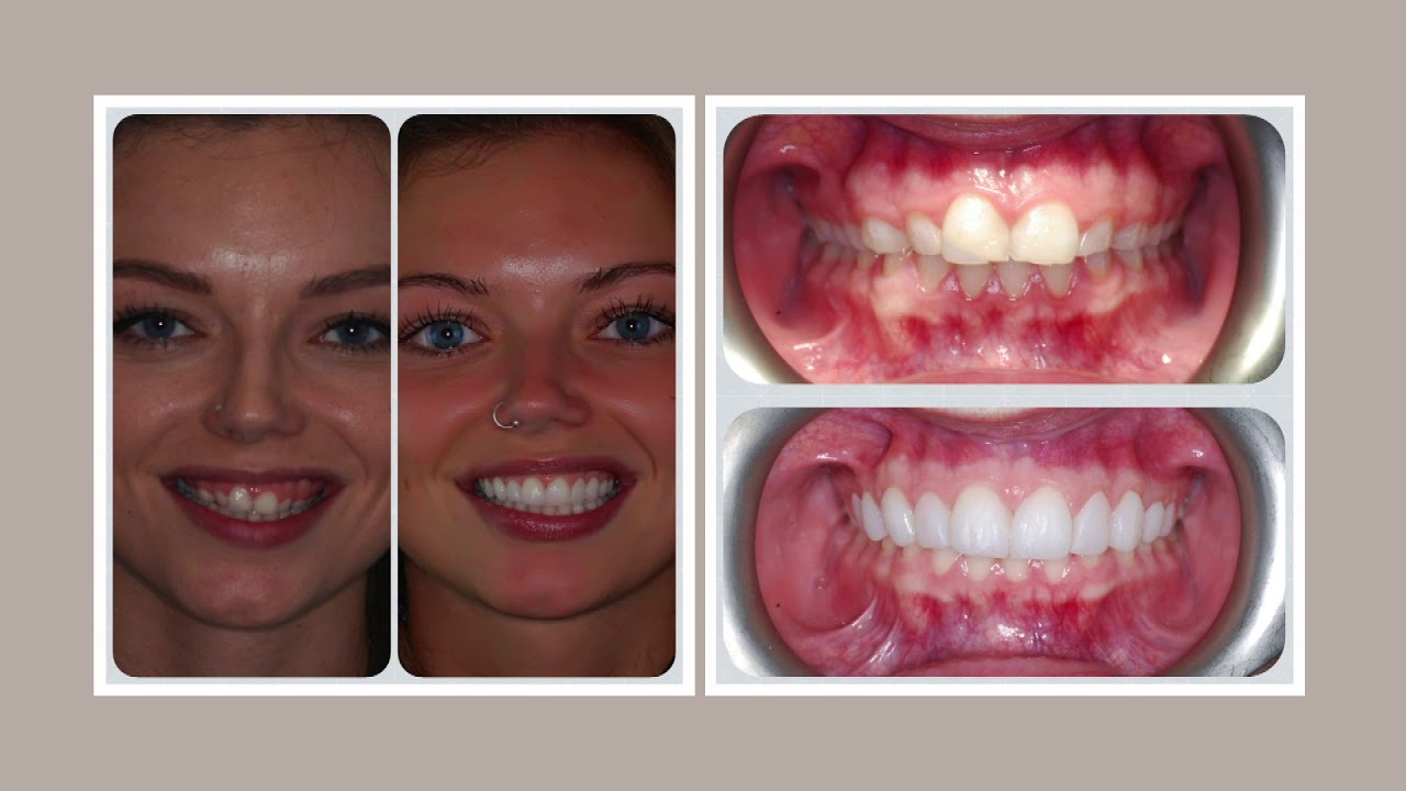 Hewett's Dental - Cosmetics - YouTube Hewett's Dental - Cosmetics - YouTube