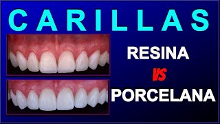 RESIN AND PORCELAIN DENTAL VENEERS ADVANTAGES AND DISADVANTAGES