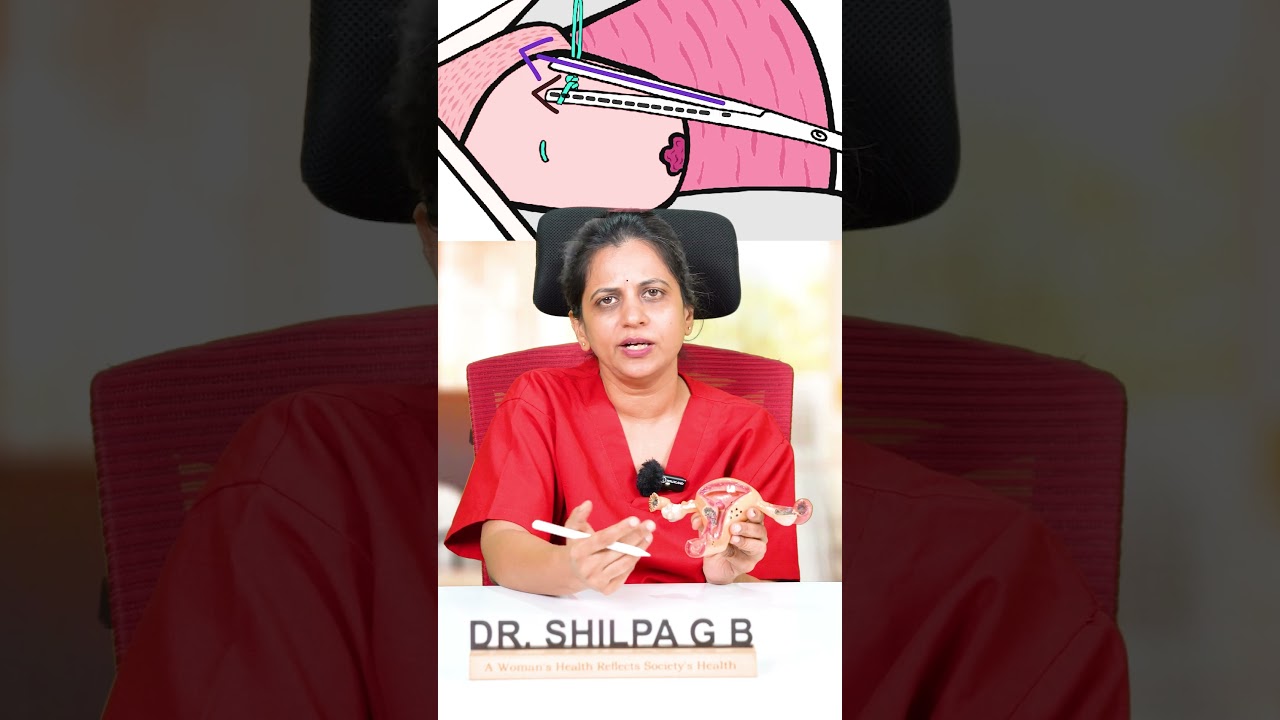 Снятие швов с шейки матки: анестезия не требуется? | Д-р Шилпа, гинеколог