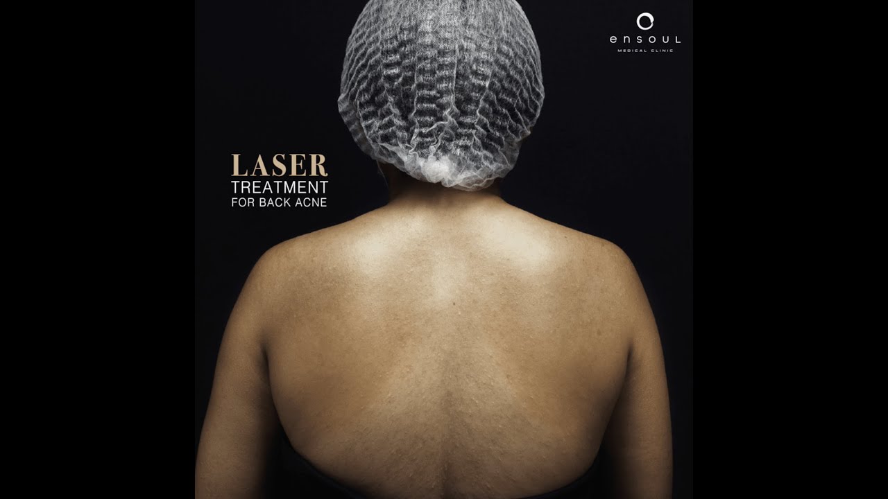 Lasers for Back Acne One of the Treatment Options You Can Consider