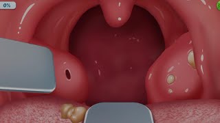 Removal Of Tonsil Stones | Asmr Dental Cleaning Procedure | Asmr Oral Health Dental Treatment