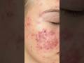 Воспаления сами не уходят. Артикул товара 173842585 #skincare #уходзакожей #уходзажирнойкожей