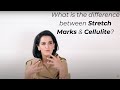What is the difference between Stretch Marks & Cellulite?|By Dr. Vali