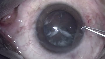 Phacoemulsification in a case with phacodonesis