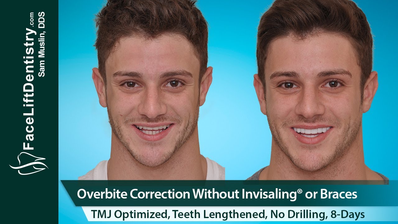 Overbite Correction with Clear Aligners in Thousand Oaks