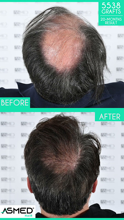 Manual FUE Hair Transplant Before & After 5538 Grafts 20-Month Result - ASMED - Dr. Koray Erdogan