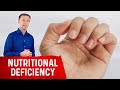 Your Nails Help Diagnose Nutrient Deficiencies