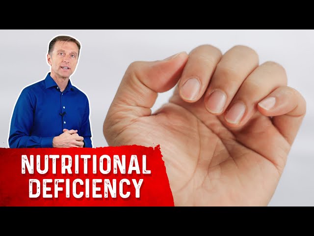 Calcium Deficiency Symptoms & Signs | Just Fitness Hub