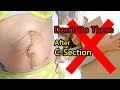 11 Things You Should Avoid After C-Section (Restrictions after C Section)