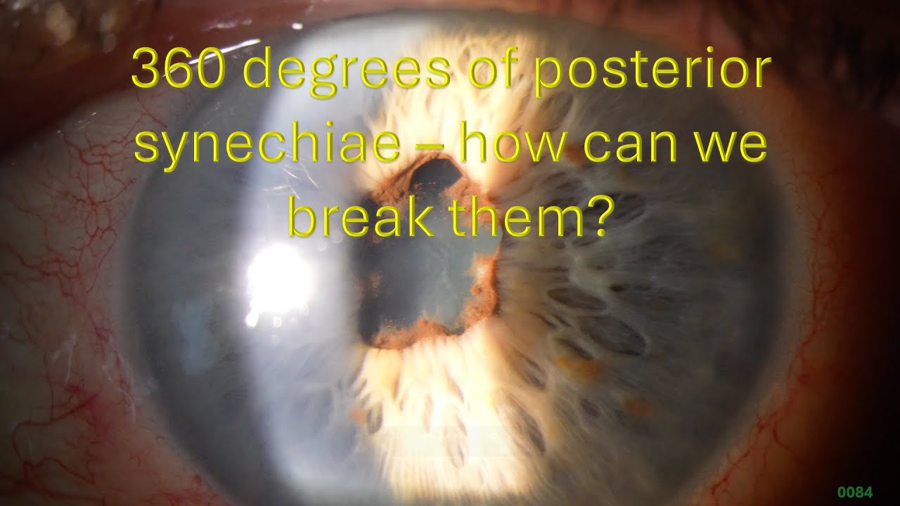 0084: 360 Degrees of Posterior Synechiae - how can we break them? - YouTube