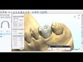 Digital crown design in 3shape dental system 2009