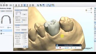 Digital Crown Design in 3Shape Dental System 2009