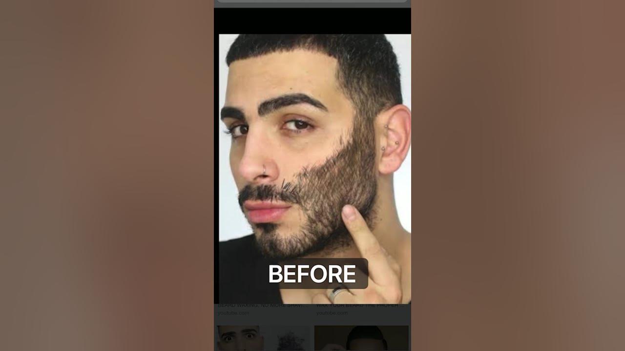 Radient Skin & ENT Clinic Laser Beard Shaping Treatment YouTube