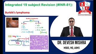 🕉 Integrated 19 subject Revision (#INR-81): Burkitt's lymphoma by Dr. Devesh Mishra.