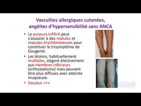 Vidéo: Dermatose Bulleuse à IgA Linéaire Chez L'adulte Et L'enfant: Une étude Clinique Et Immunopathologique De 38 Patients