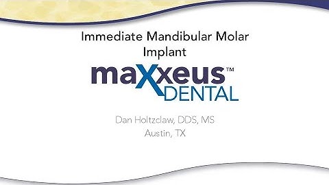 Immediate Mandibular Molar Implant