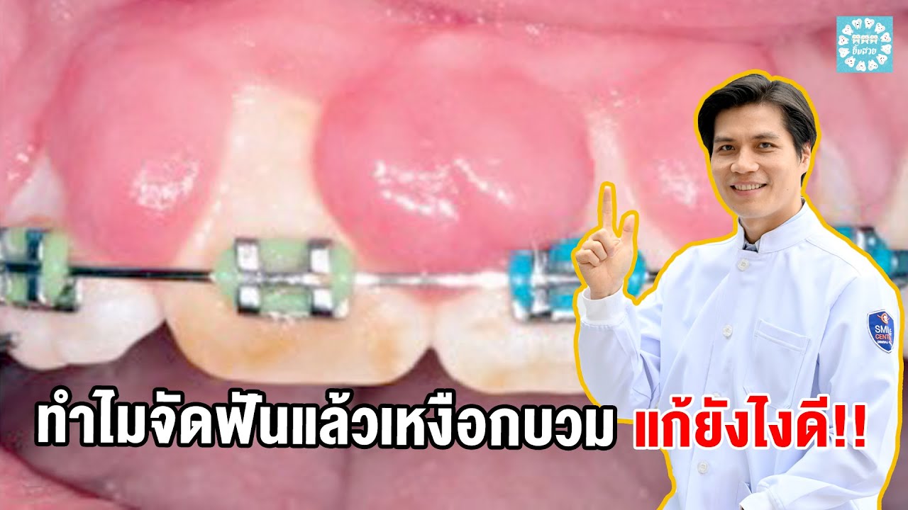 ทำไมจัดฟันแล้วเหงือกบวม เหงือกอักเสบ แก้ยังไงดี!! - Youtube