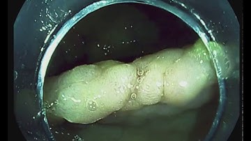 EMR of a large flat colon polyp