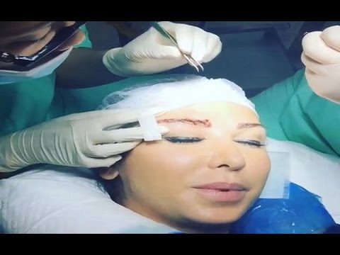 فيديو جويل مردينيان تخضع لعملية زراعة شعر الحاجبين