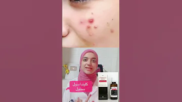 أسهل حل في خطوتين للتخلص من الحبوب المزعجة في الوجه في يوم واحد 