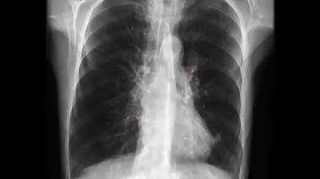 Chest X-Ray (CXR) Analysis
