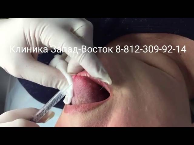 Лазерное удаление папиллом на языке